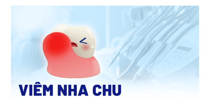 Viêm nha chu là gì? Nguyên nhân, triệu chứng, chẩn đoán và cách điều trị