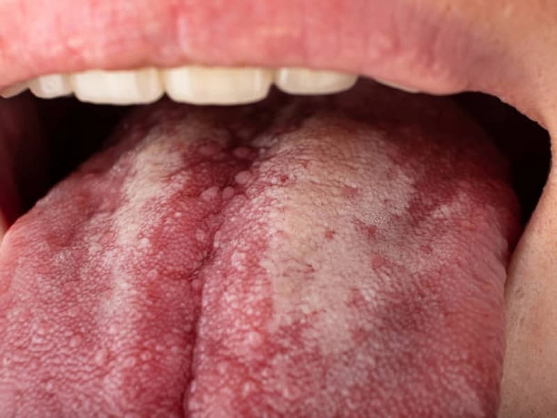 Tưa miệng là gì? Những điều cần biết về tưa miệng