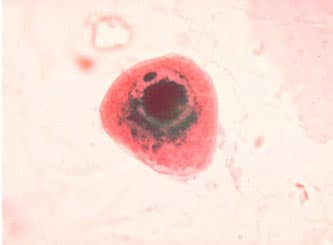 Nhiễm Cytomegalovirus (CMV): Những điều cần biết để phòng tránh và điều trị