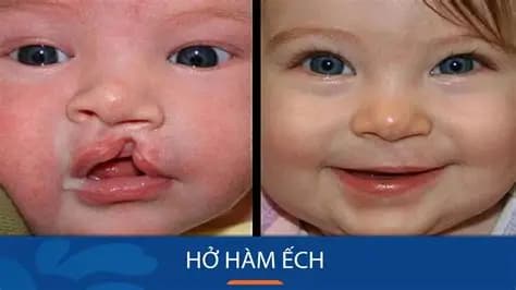 Hở hàm ếch: Nguyên nhân, biểu hiện, cách điều trị và phòng bệnh