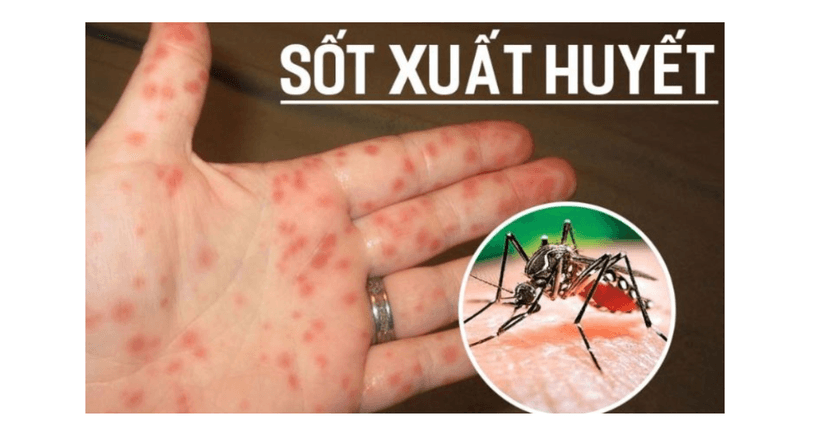 Sốt Xuất Huyết: Nguyên Nhân, Triệu Chứng và Cách Điều Trị Hiệu Quả