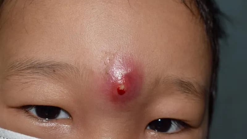 U hạt mạn tính là gì? Những điều cần biết về u hạt mạn tính