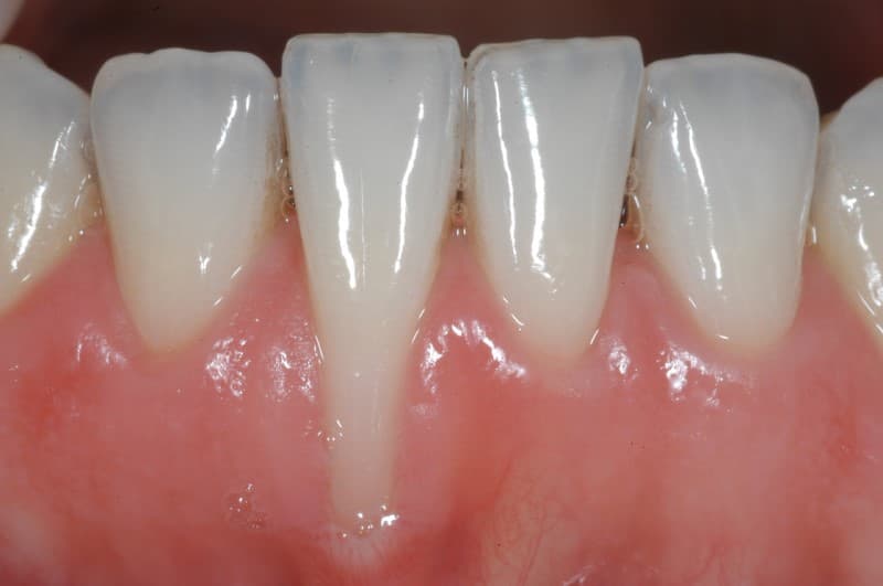 Tụt lợi là gì? Nguyên nhân, triệu chứng và cách điều trị