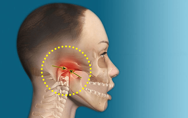 Rối Loạn Khớp Thái Dương Hàm: Nguyên Nhân, Triệu Chứng Và Cách Điều Trị