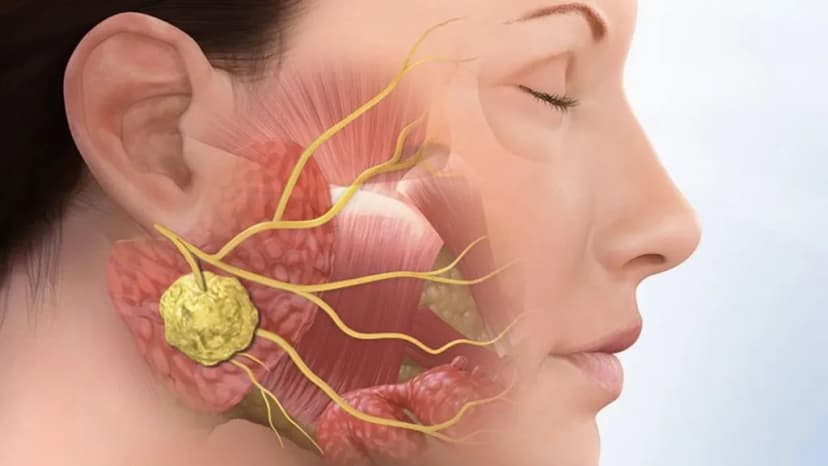 U xương hàm là gì? Những điều cần biết về u xương hàm