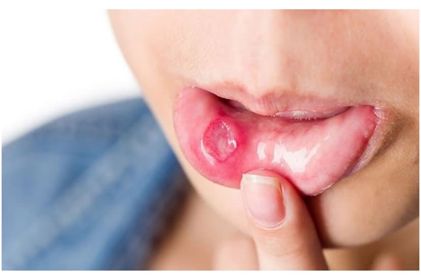Viêm loét niêm mạc miệng, lưỡi: Những điều cần biết