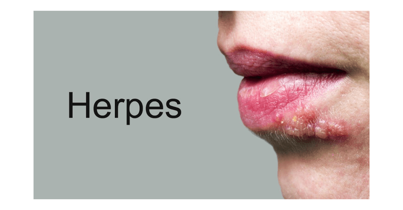 Herpes môi: Những điều cần biết về nguyên nhân, triệu chứng và cách điều trị