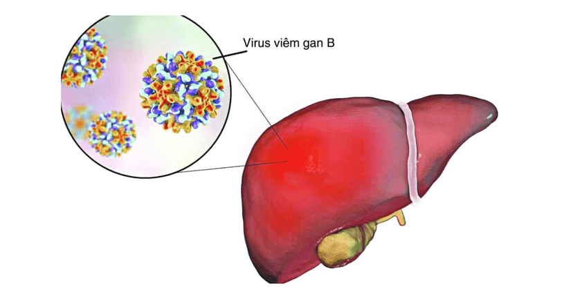 Viêm Gan B: Nguyên Nhân, Triệu Chứng, Chẩn Đoán Và Phương Pháp Điều Trị