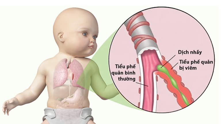 Viêm tiểu phế quản là gì? Dấu hiệu, nguyên nhân, chẩn đoán và cách điều trị