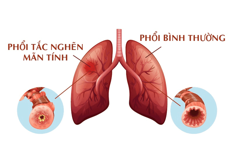 Bệnh phổi tắc nghẽn mạn tính là gì? Triệu chứng, nguyên nhân và phương pháp điều trị