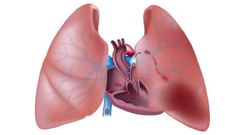 Tắc động mạch phổi là gì? Những điều cần biết về thuyên tắc phổi