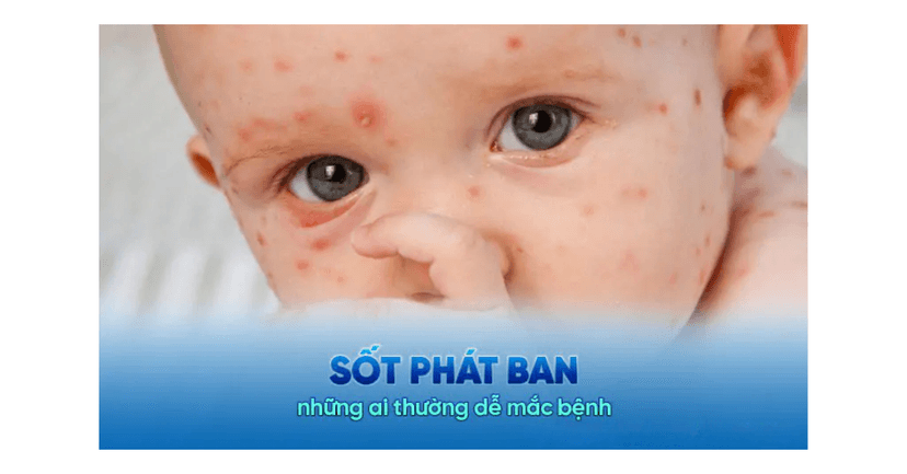 Sốt Phát Ban Là Gì? Triệu Chứng, Nguyên Nhân, Cách Phòng Ngừa Và Điều Trị