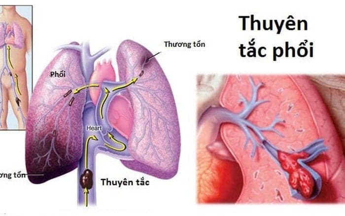 Xuất huyết phế nang lan tỏa