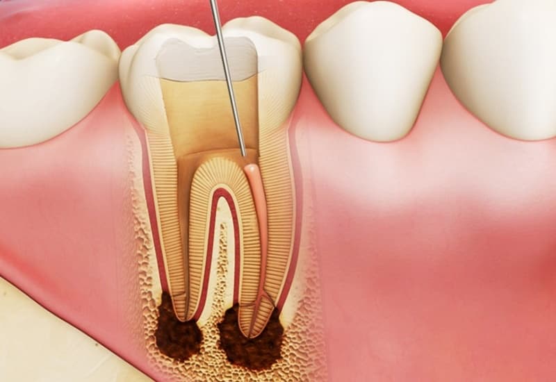 Viêm Tủy Răng Là Gì? Nguyên Nhân, Triệu Chứng và Cách Phòng Ngừa Hiệu Quả