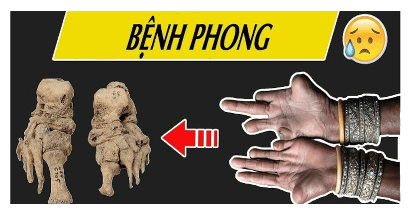 Bệnh Phong Và Những Điều Cần Biết Về Bệnh Phong