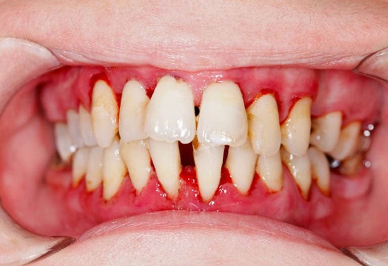 Bệnh Nướu Và Nha Chu Là Gì? Nguyên Nhân, Triệu Chứng và Cách Phòng Ngừa Hiệu Quả