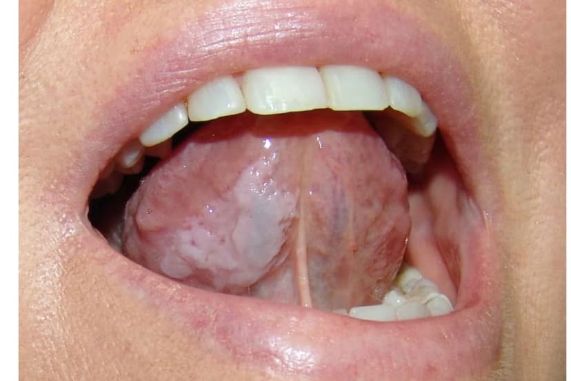 Bạch sản là gì? Những điều cần biết về bạch sản