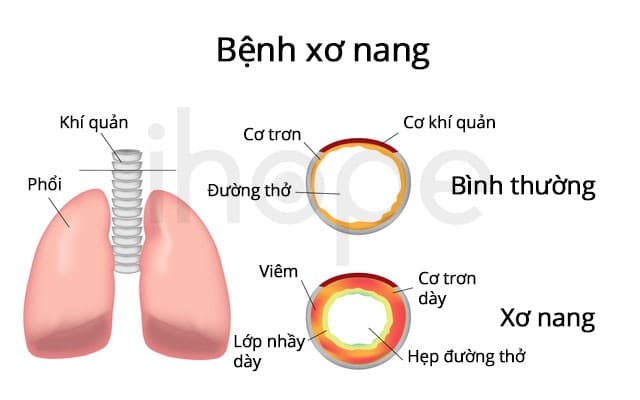 Xơ nang là gì? Nguyên nhân, triệu chứng và phương pháp phòng ngừa