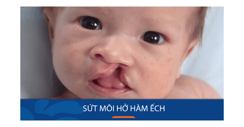 Sứt môi và hở hàm ếch là gì? Những điều cần biết về sứt môi và hở hàm ếch