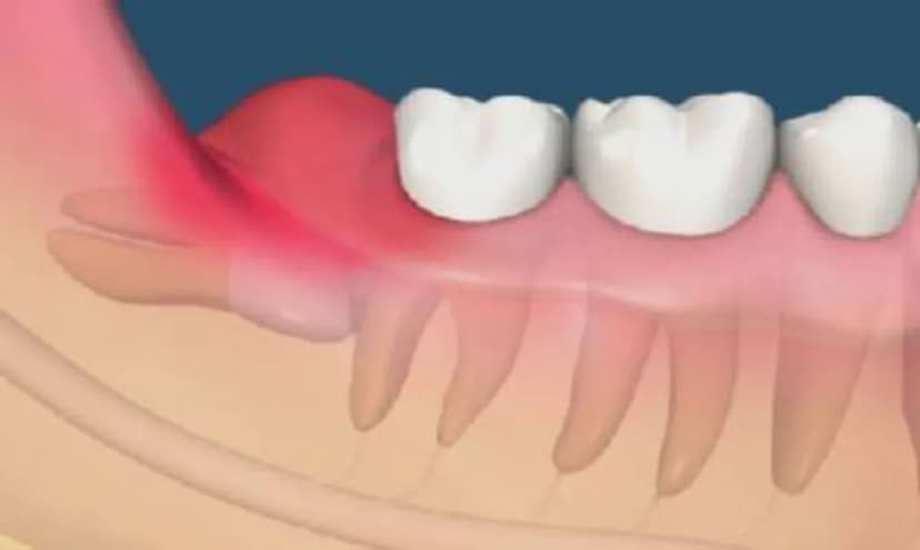 Răng Mọc Kẹt: Dấu Hiệu, Nguyên Nhân Và Hướng Xử Lý Hiệu Quả
