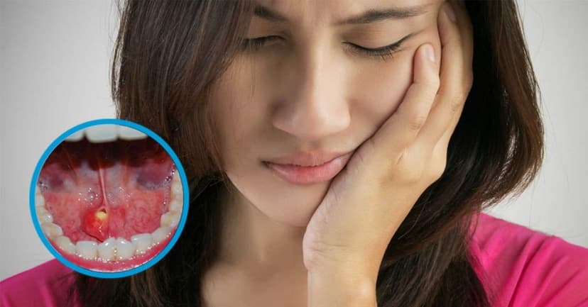 Viêm Tuyến Nước Bọt Là Gì? Nguyên Nhân, Triệu Chứng và Cách Phòng Ngừa Hiệu Quả
