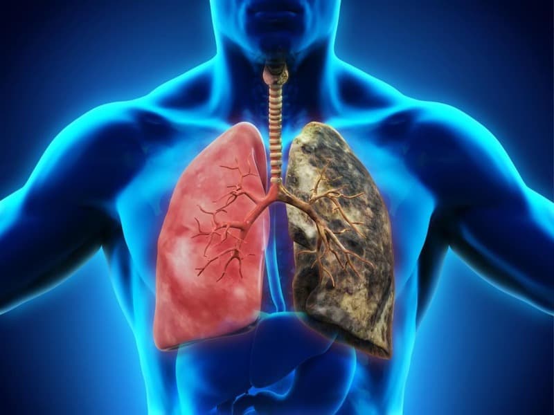 Phổi kẽ là gì? Những điều bạn cần biết về căn bệnh này