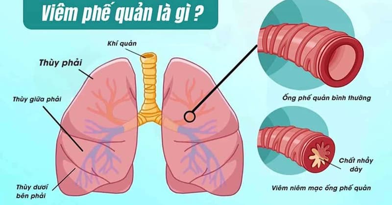 Viêm Phế Quản: Nguyên Nhân, Triệu Chứng, Cách Chẩn Đoán Và Điều Trị