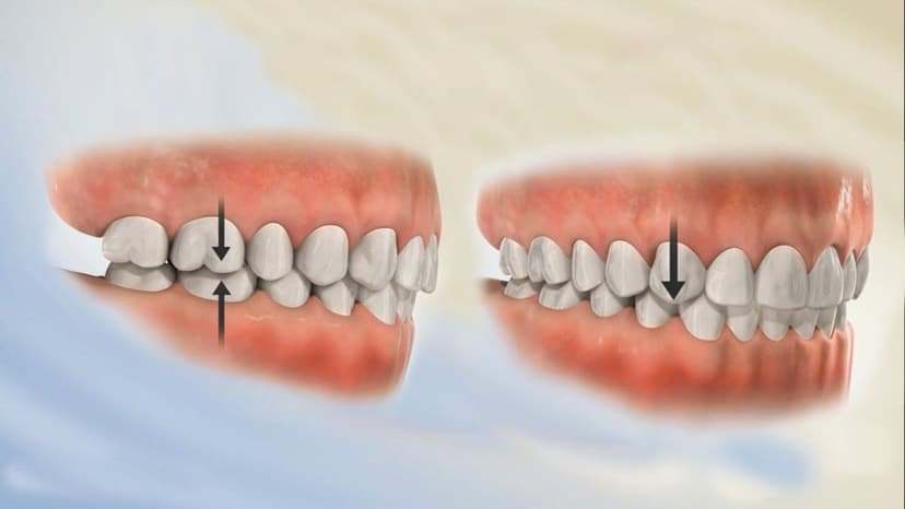 Lệch khớp cắn: Nguyên nhân, biểu hiện, cách điều trị và phòng bệnh