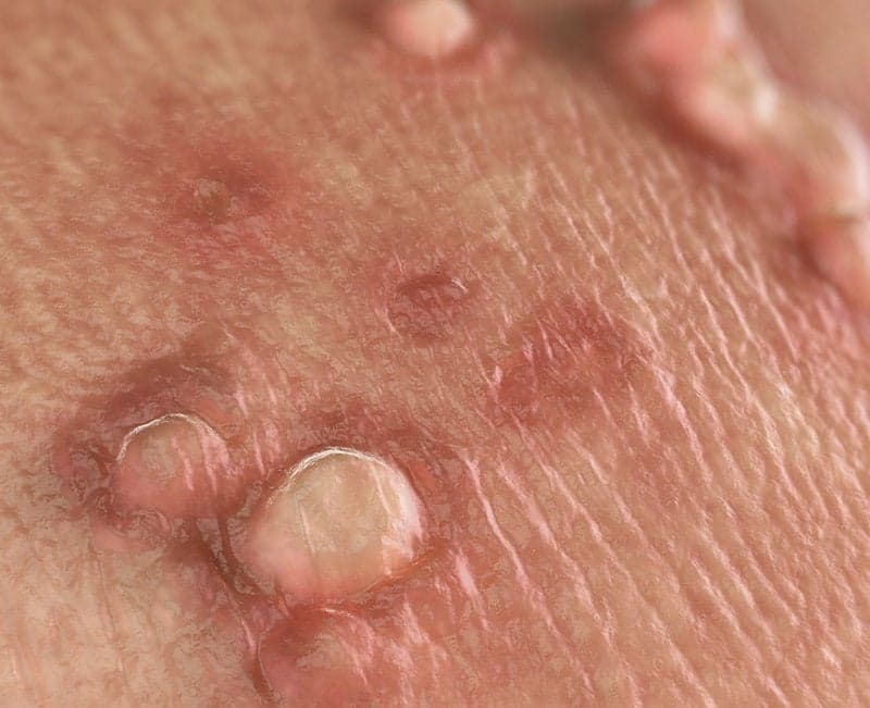 Mụn cơm sinh dục: Nguyên nhân, triệu chứng và cách phòng ngừa hiệu quả