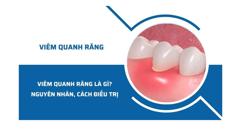 Viêm quanh răng là gì? Những điều cần biết về viêm quanh răng
