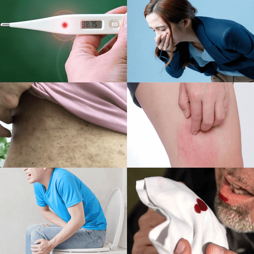 Sán Lá Phổi (Paragonimiasis): Tổng quan và những điều cần biết