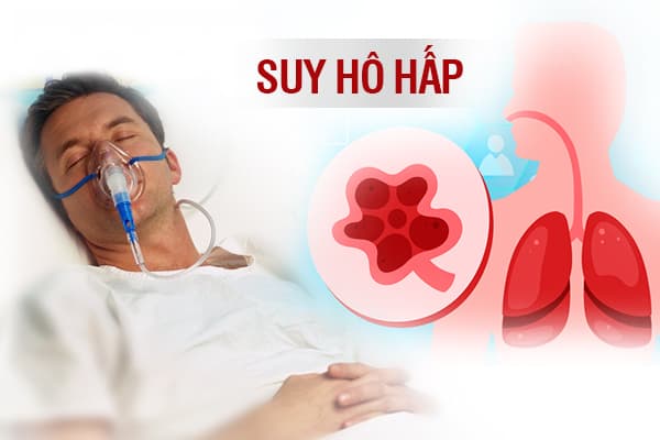 Hiểu Đúng Về Suy Hô Hấp: Nguyên Nhân, Triệu Chứng Và Giải Pháp Điều Trị