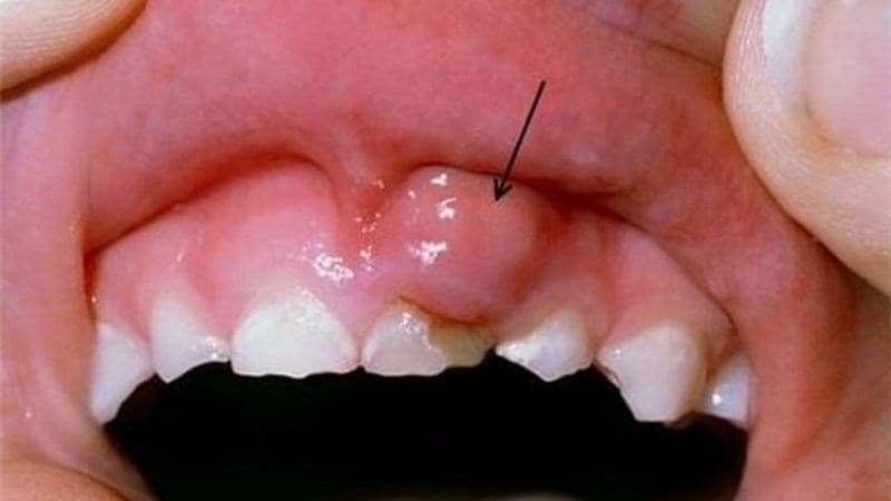 Ung thư nướu răng là gì? Những điều cần biết về ung thư nướu răng