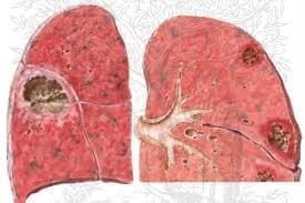 Xơ phổi vô căn là gì? Những điều cần biết về xơ phổi vô căn
