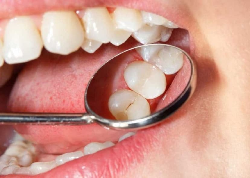 Sâu răng: Nguyên nhân, triệu chứng, điều trị và cách phòng ngừa