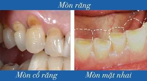 Mòn răng: Nguyên nhân, triệu chứng, cách điều trị và phòng bệnh