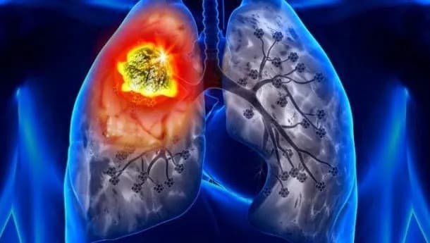 Bụi phổi atbet (amiăng) là gì? Những điều cần biết