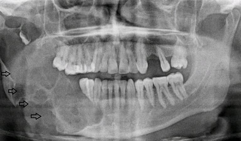U men xương hàm là gì? Những điều cần biết về u men xương hàm