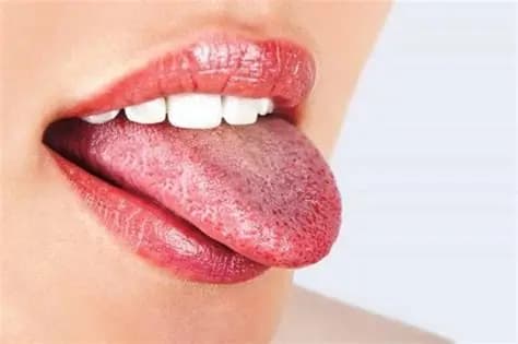 Nấm Miệng Là Gì? Nguyên Nhân, Triệu Chứng và Cách Điều Trị Hiệu Quả