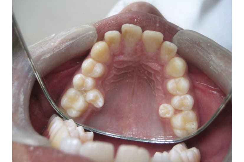Răng thừa là gì? Những điều cần biết về răng thừa