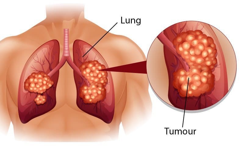 Ung thư phế quản là gì? Những điều cần biết