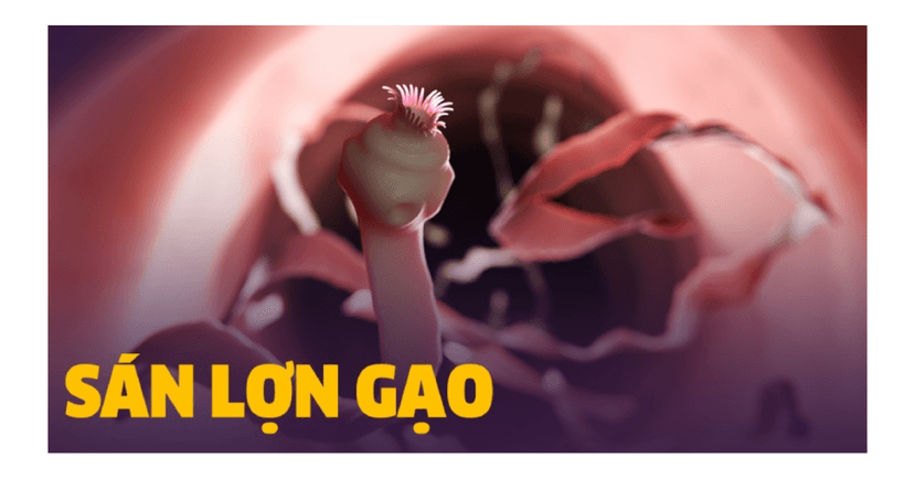 Sán lợn gạo: Nguyên nhân, triệu chứng và cách phòng chống hiệu quả