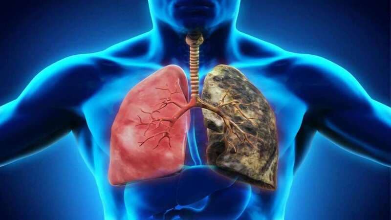 Viêm màng phổi là gì? Những điều cần biết về viêm màng phổi